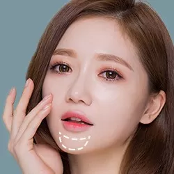 Độn cằm