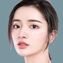 Độn gò má