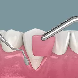 Ghép nướu trên Implant