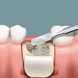 Ghép xương nhân tạo