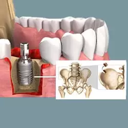 Ghép xương chậu