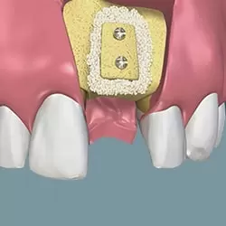 Ghép xương tự thân