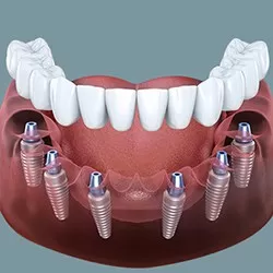 Implant toàn hàm<br>All on 6