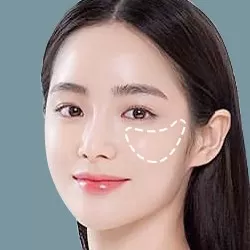 Lấy túi mỡ má