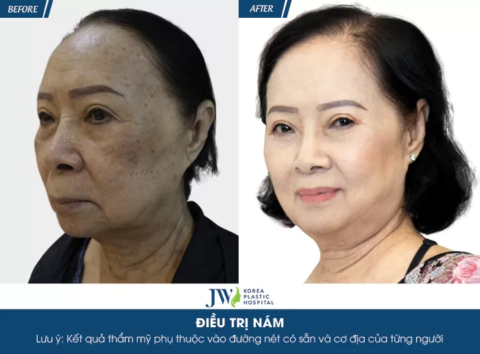 Ca sĩ Đông Quân phát cuồng với làn da đẹp của người phụ nữ U75 sau trị nám