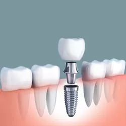 Răng tạm cố định trên Implant