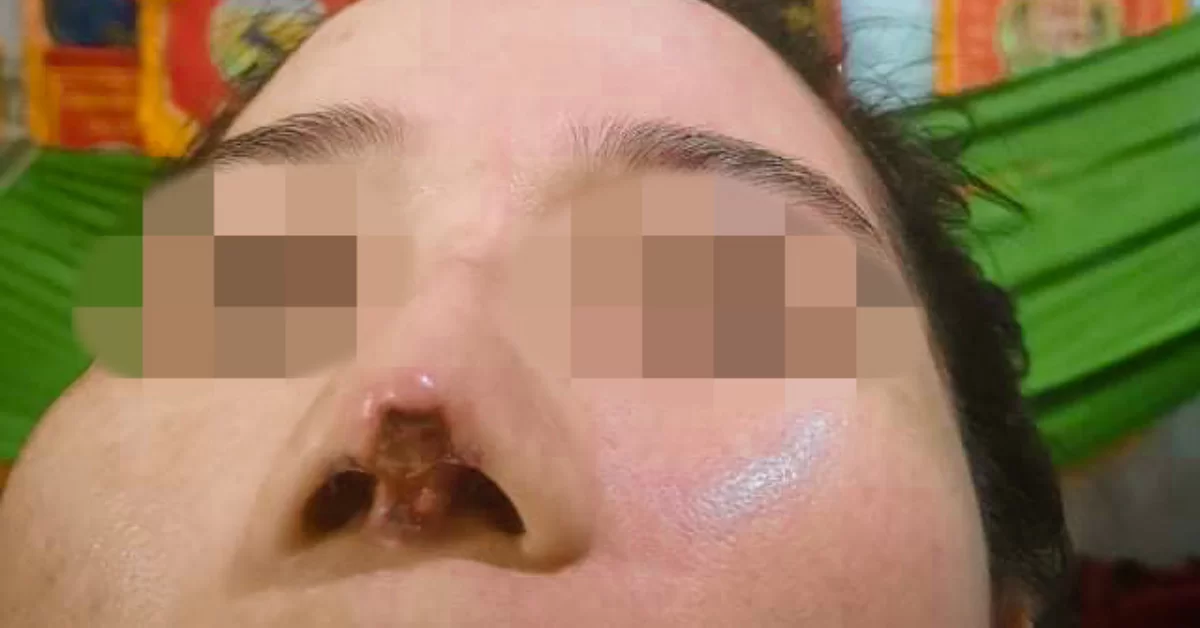 Lại một cô gái bị thối rữa mũi do nâng sụn dởm ở spa chui