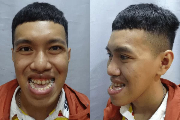 Bác sĩ Tú Dung cắt hàm giải cứu chàng trai móm nặng 26 năm không khép được miệng