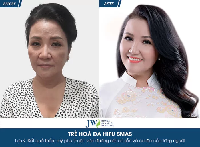 tre-hoa-da-hifu_ngan-quynh1