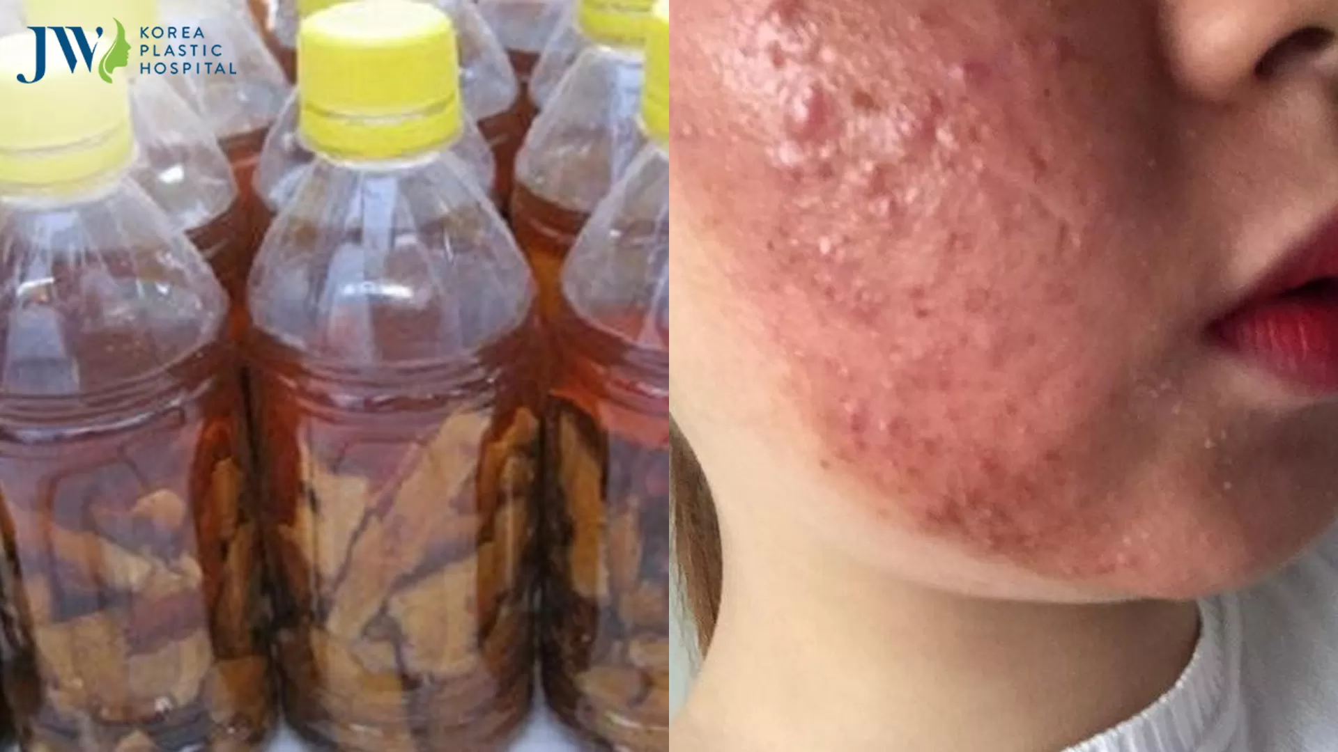 Lột da bằng hoá chất khiến nhiều người gặp biến chứng kinh hoàng