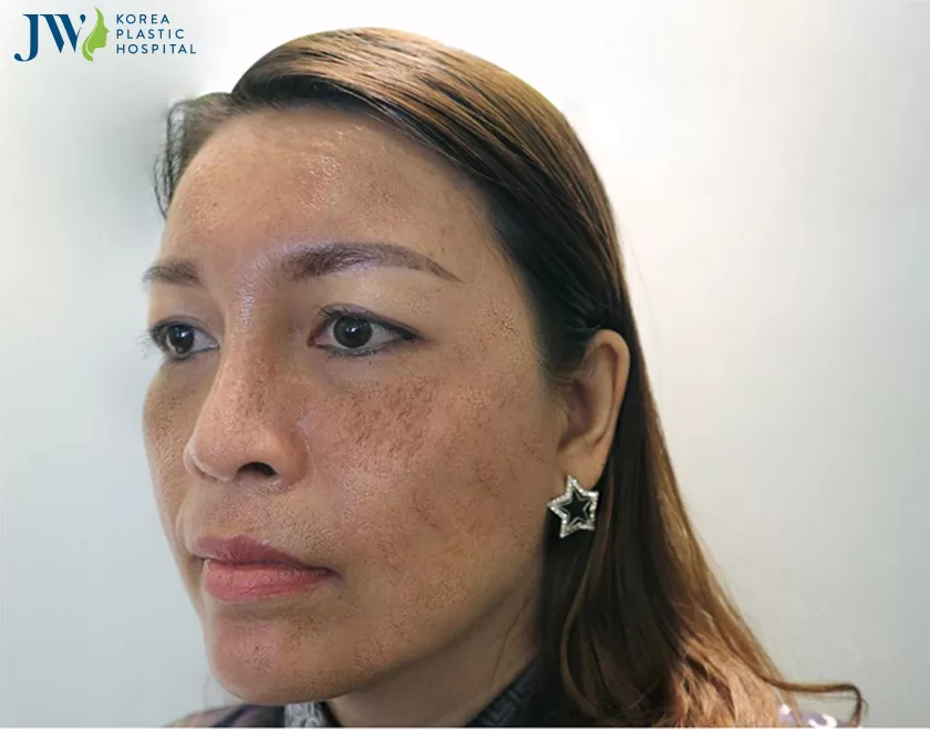 Chị Kim Hưởng bị nám nặng do sử dụng kem trộn lâu năm