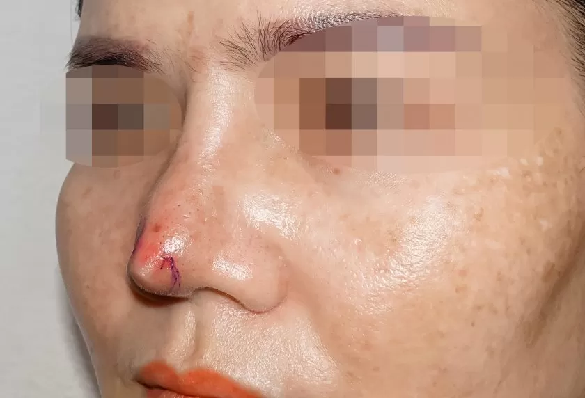 Chiếc mũi nhọn hoắt