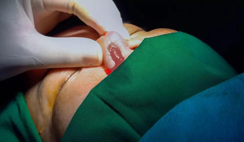 Mũi bệnh nhân bị viêm nhiễm