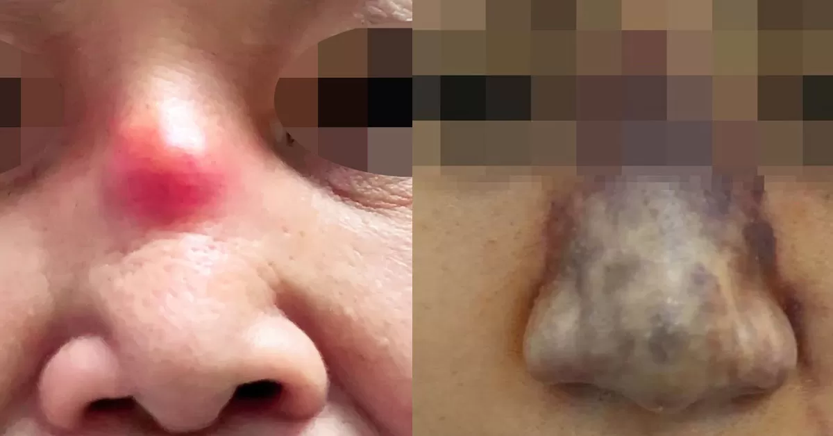 Biến chứng do tiêm filler nâng mũi ở Spa, Bác sĩ Tú Dung nạo filler và nâng mũi cấu trúc S Line