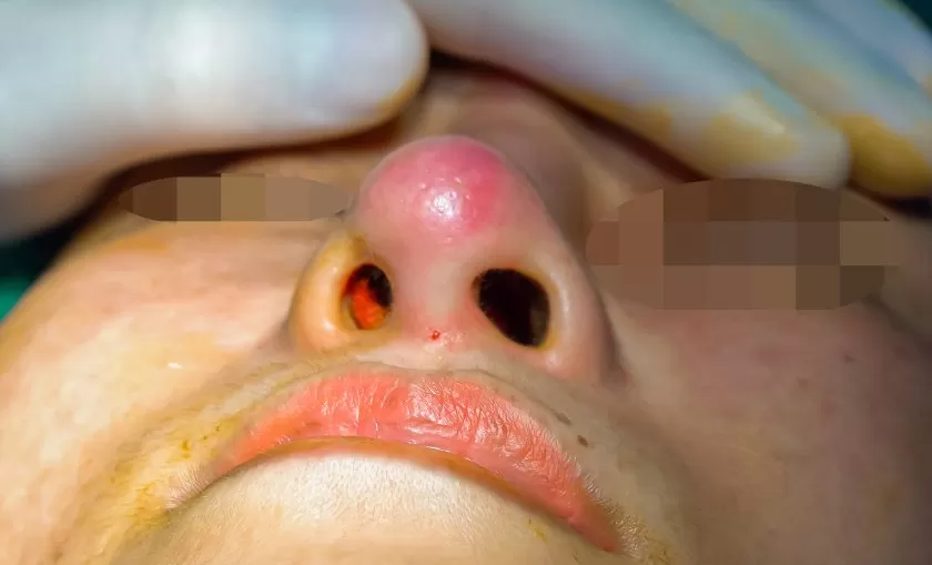 biến chứng thẫm mỹ