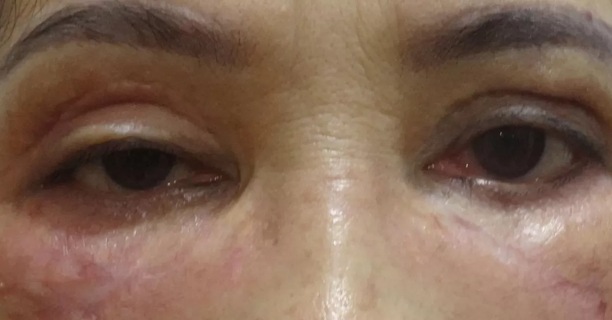 Sụn mũi xuyên trán, đầu mũi xì dịch, mắt trợn thâm tím đen vì spa ghép da man rợ