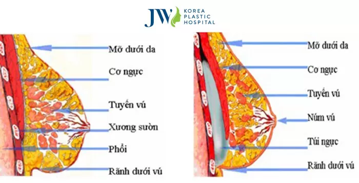 nâng ngực