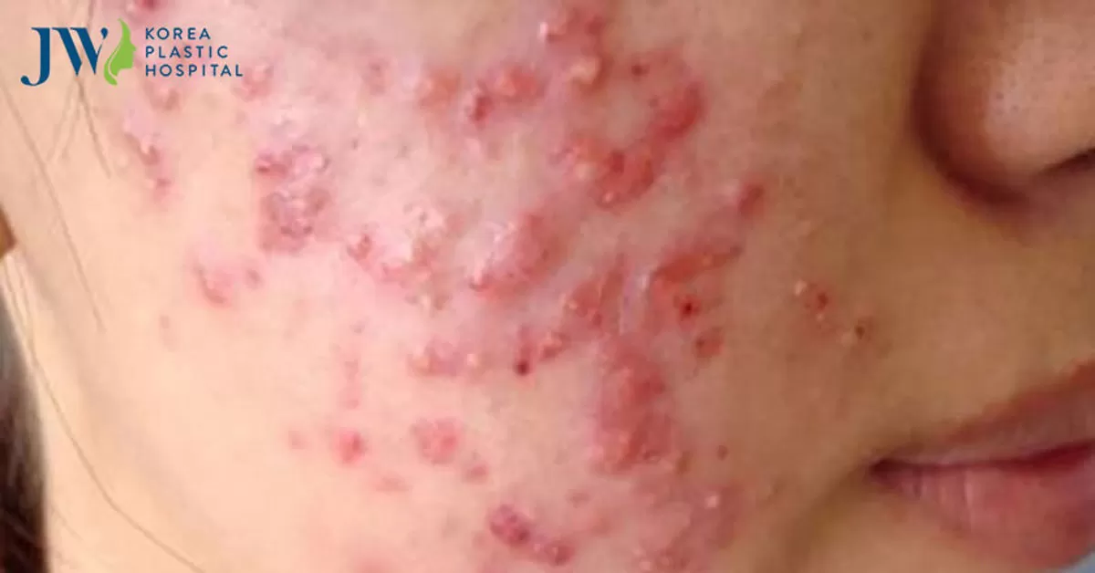 Phát ban mụn trứng cá: nguy hiểm nếu không điều trị kịp thời