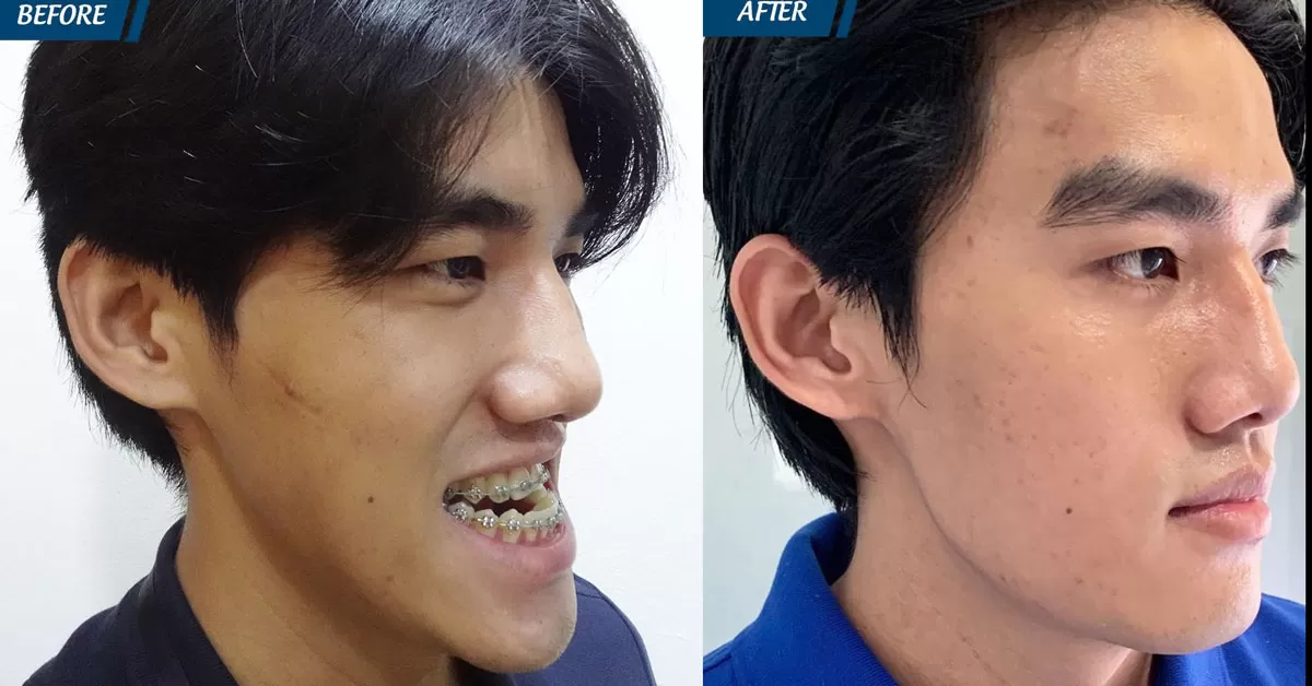 Thoát kiếp hàm móm, 9X hoá hotboy Hàn Quốc khiến mẹ ruột không nhận ra
