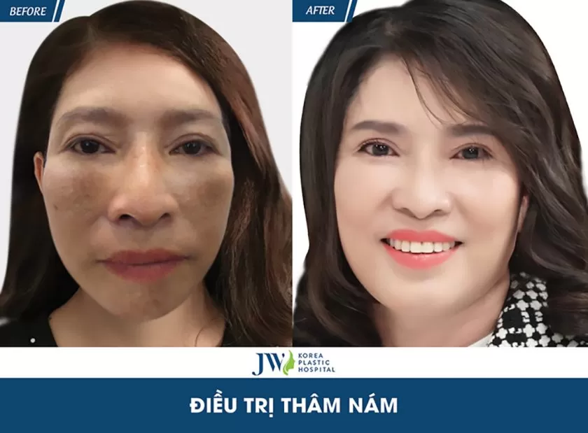 Kết quả điều trị khách dùng kem trộn chứa corticoid