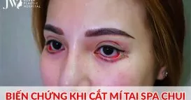 07 sai lầm khi đi cắt mí mắt