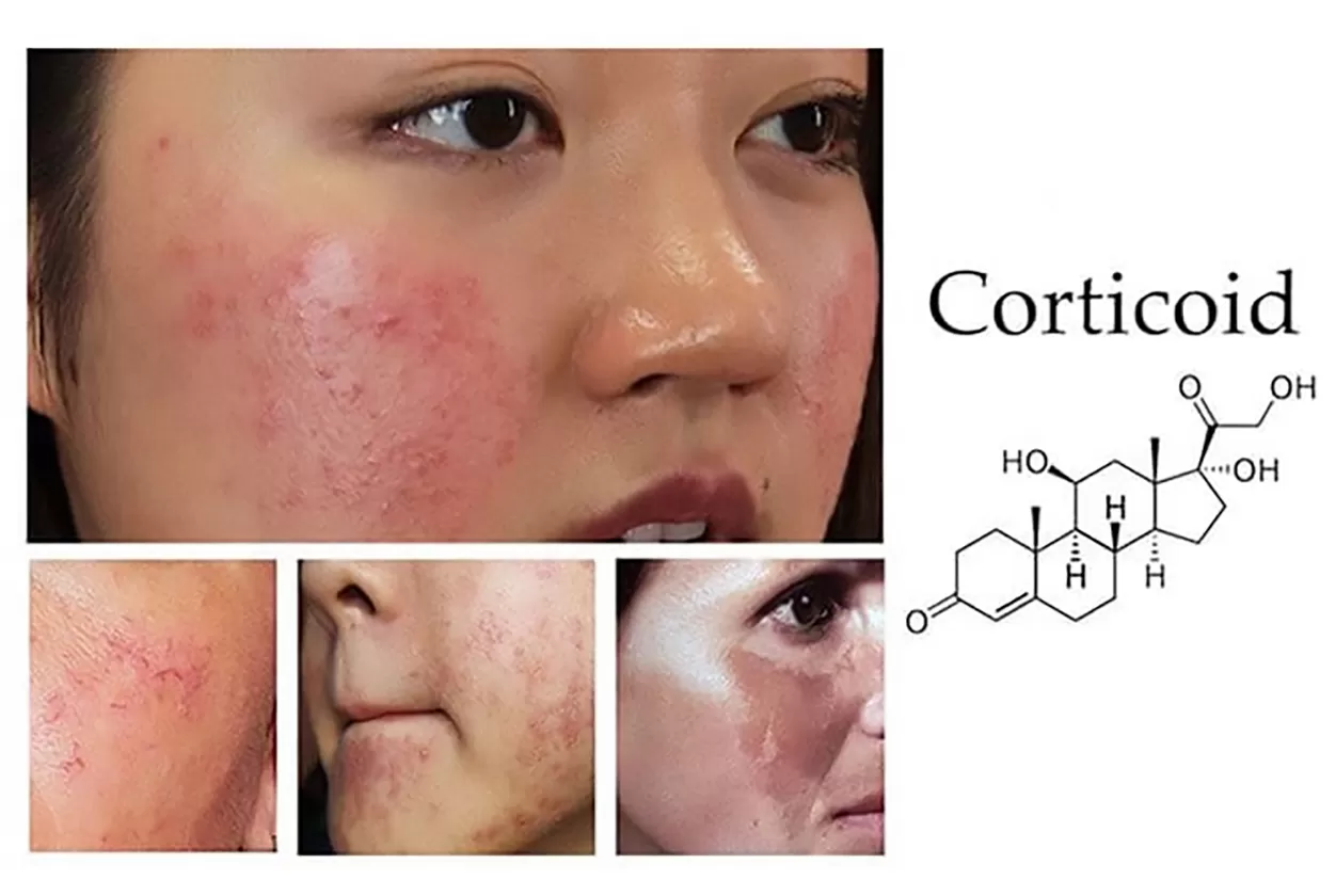 Dấu hiệu da nhiễm corticoid từ kem trộn
