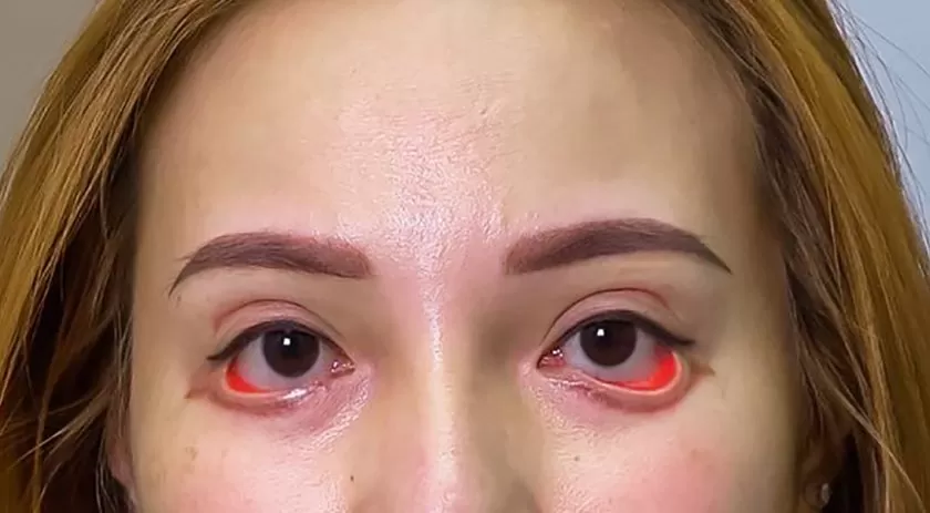 Ca mắt "quỷ" ngấn máu do bị spa chui bóc tách mỡ và cắt mí