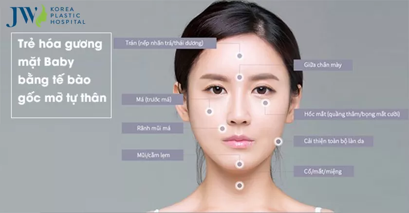 Các vùng trên khuôn mặt có thể cấy mỡ