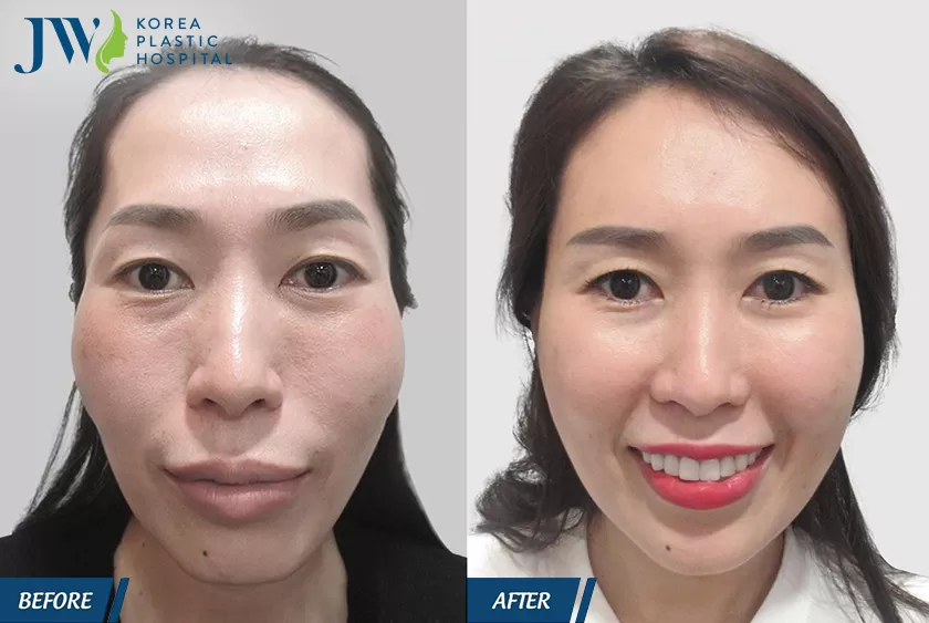 Nữ khách trẻ trung hơn sau khi thực hiện cấy mỡ mặt