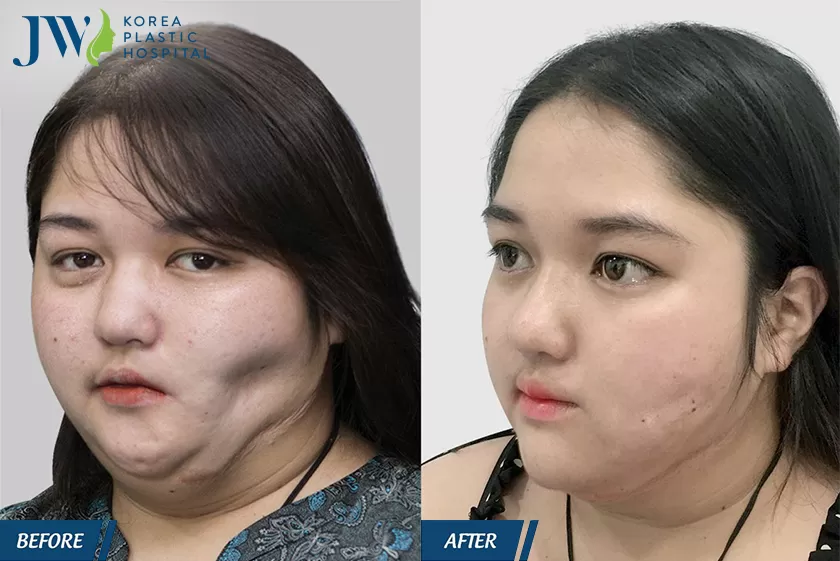 Nhân vật Nhan sắc mới- Khởi đầu mới sau khi cấy mỡ mặt