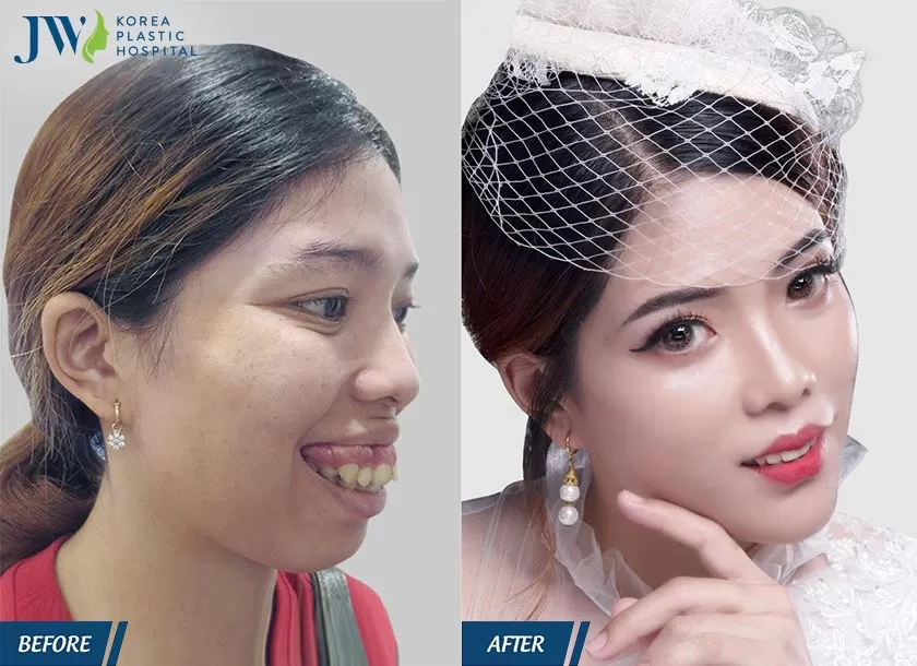 Chân dung khách hàng Tố Uyên sau khi phẫu thuật hàm hô