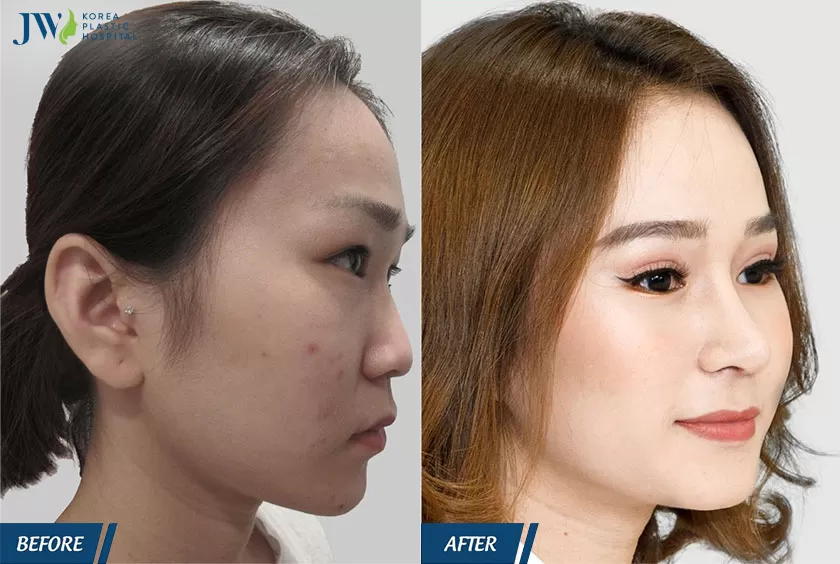Hình ảnh chị Thanh Thúy sau khi sửa mũi