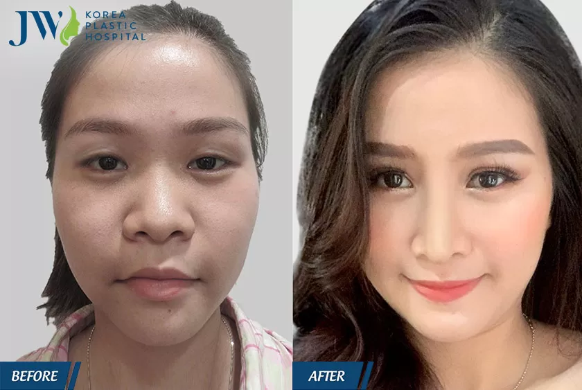 Trúc Oanh hóa "hot girl" vạn người mê sau khi phẫu thuật mắt và mũi