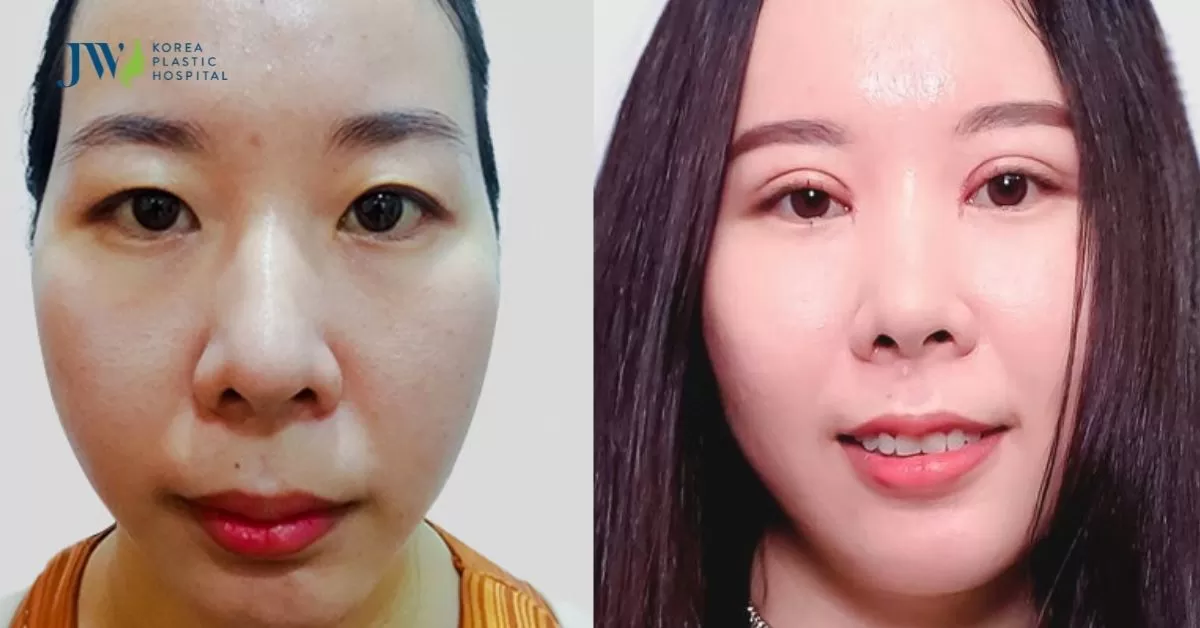 Phẫu thuật mắt hai mí ở đâu ít thảm hoạ nhất?