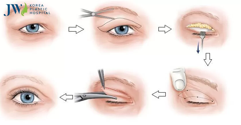 Bệnh viện thẩm mỹ mắt 