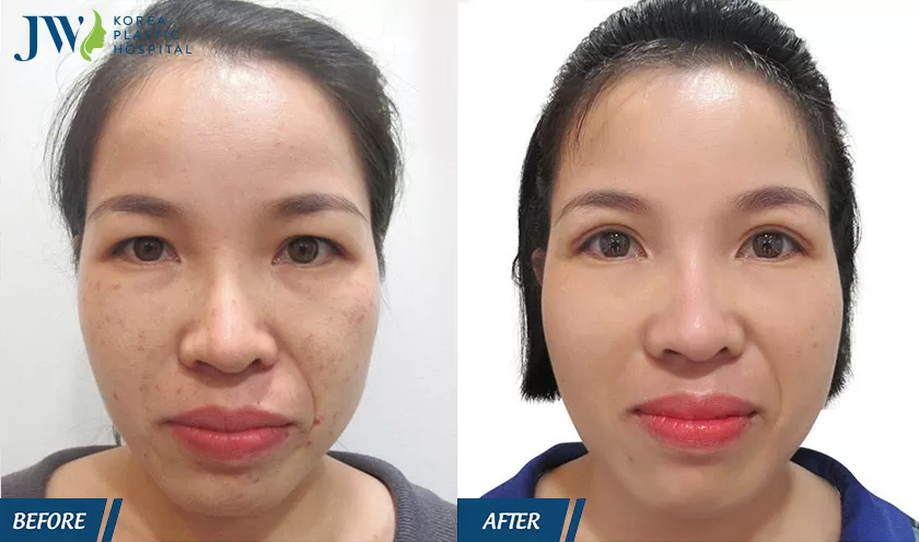 Phẫu thuật thẩm mỹ mắt