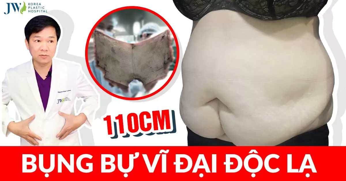 Cắt mỡ tạo hình thành bụng an toàn với 3 nguyên tắc vàng