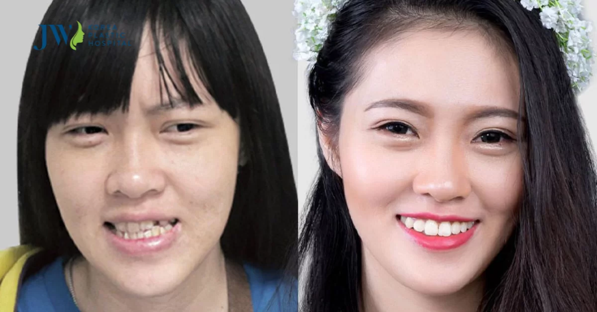 Phẫu thuật thẩm mỹ mặt lệch ở đâu an toàn và không đau?
