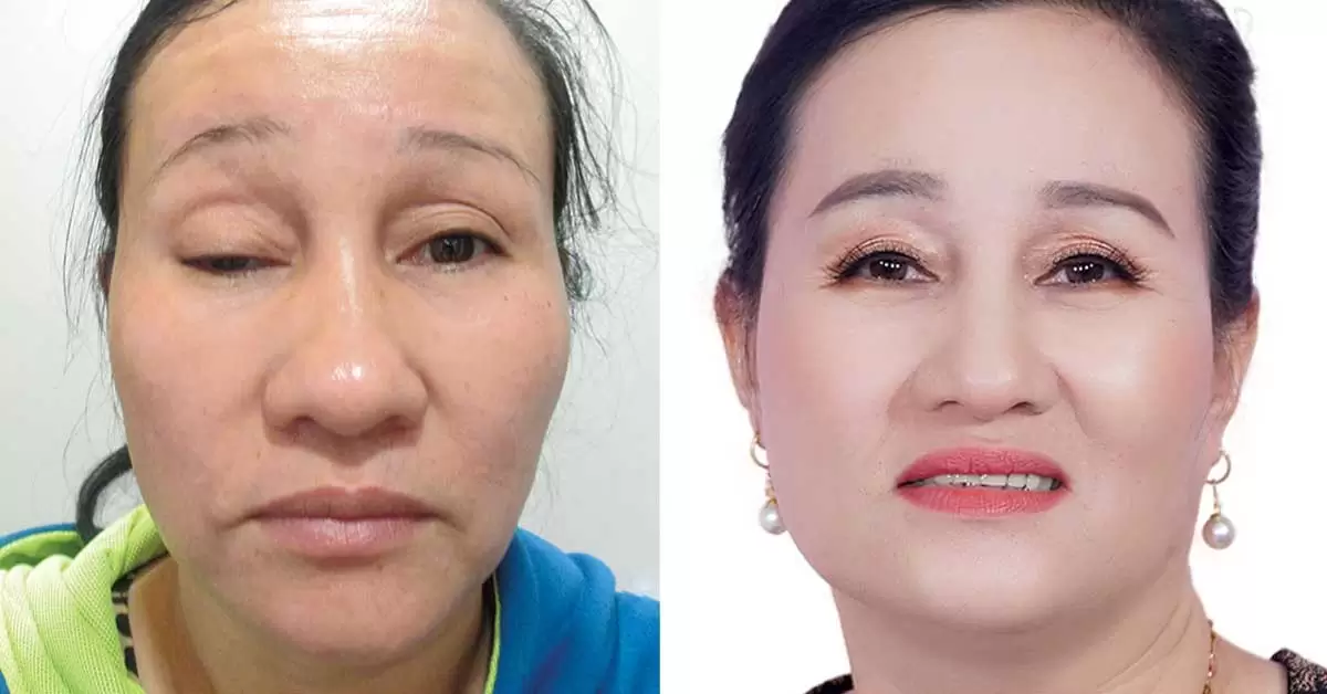 Mắt đẹp tự nhiên sau phẫu thuật nâng cơ mí mắt