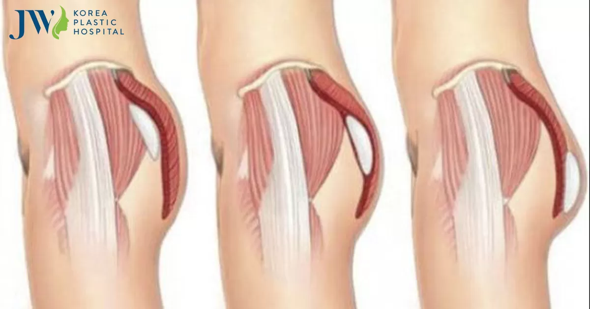 Phẫu thuật mông hóp: tái tạo vòng 3 hoàn mỹ quyến rũ