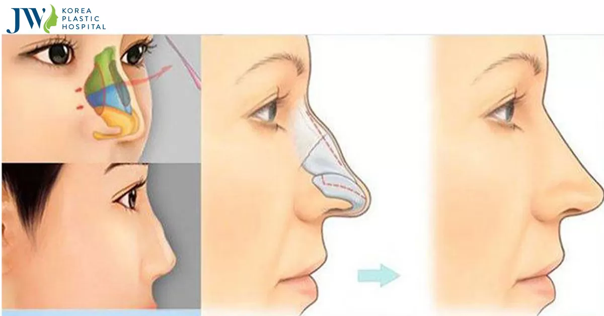 Bệnh viện nâng mũi uy tín vạn người mê tại TP.HCM