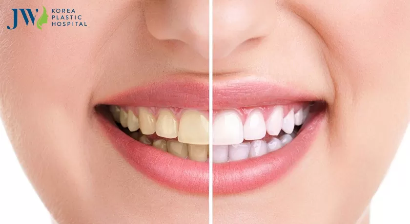 Cách làm trắng răng bị ố vàng tại nhà nhanh chóng tức thì