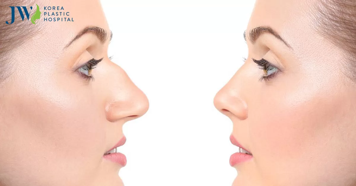 Dáng mũi gãy là mũi gì? Sửa sống mũi gãy có khó không?