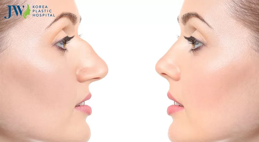 Dáng mũi gãy sẽ trông như thế nào?