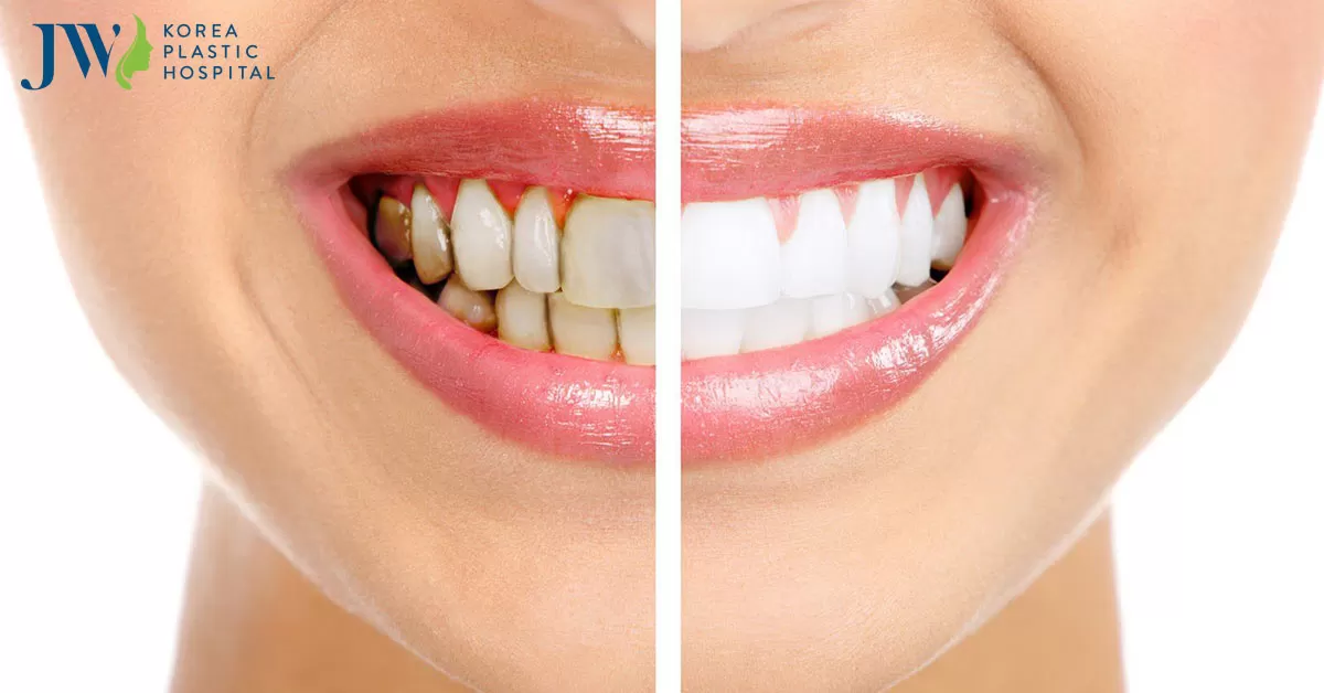 Lấy cao răng tại nhà hiệu quả nhanh loại bỏ ố vàng chỉ trong vài phút