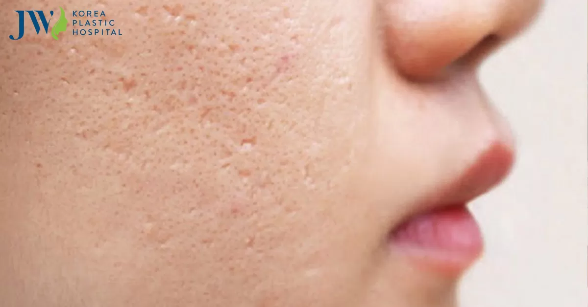 Cách làm se khít lỗ chân lông tại nhà với nguyên liệu từ thiên nhiên