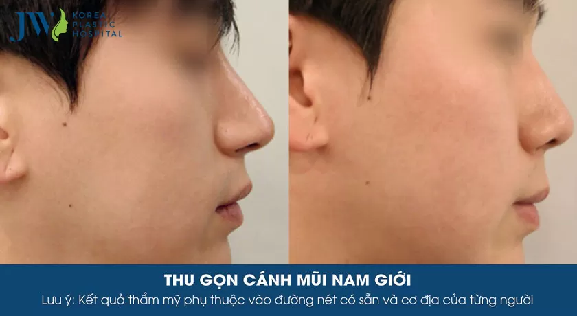 Cắt cánh mũi giá bao nhiêu?