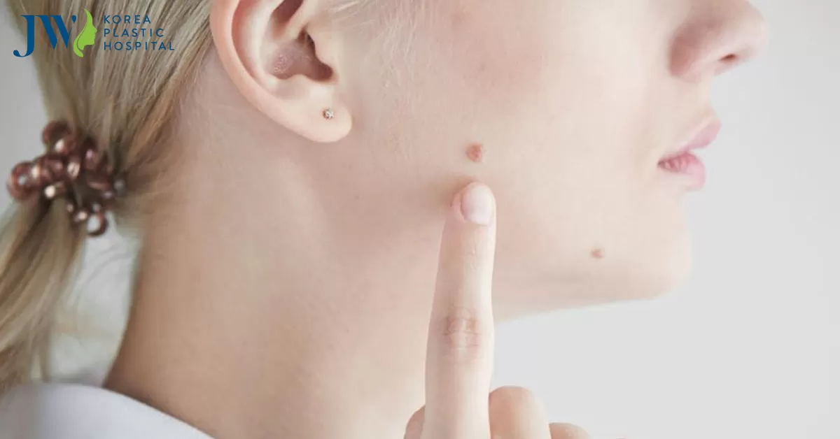 Tẩy nốt ruồi tại nhà nhanh chóng dứt điểm như điều trị ở spa