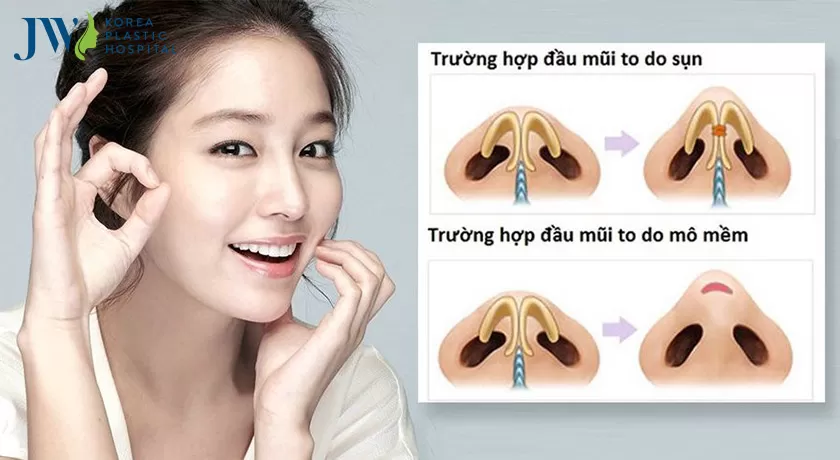 Bí kíp xóa nếp nhăn rãnh mũi má không cần phẫu thuật thẩm mỹ