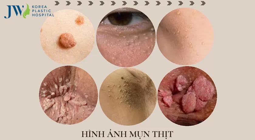 Trị mụn thịt ở mũi có được không?